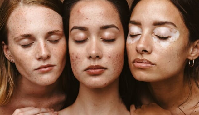 そばかす、にきび、白斑のある3人の女性